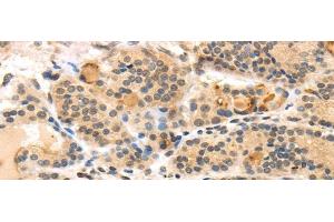 Immunohistochemistry of paraffin-embedded Human thyroid cancer using TUSC5 Polyclonal Antibody at dilution of 1/40 (TUSC5 Antikörper)