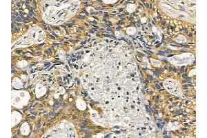Cytochrome P450 4F12 Mouse Monoclonal Antibody at 1/100 staining human lung cancer and adjacent non-tumor tissue by IHC-P.