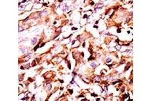 IHC analysis of FFPE human breast carcinoma tissue stained with the phospho-Bad antibody.