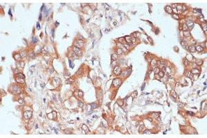 Immunohistochemistry of paraffin-embedded Human lung cancer using PTPRN2 Polyclonal Antibody at dilution of 1:100 (40x lens). (PTPRN2 Antikörper)