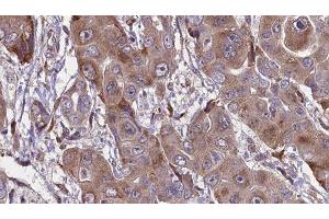 ABIN6276598 at 1/100 staining Human liver cancer tissue by IHC-P. (FCGR1A Antikörper  (Internal Region))