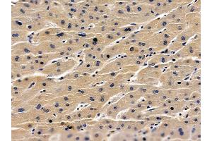 ABIN6259600 and ABIN6275767 at 1/100 staining human liver cancer by IHC-P.