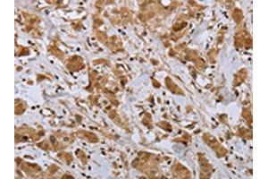 The image on the left is immunohistochemistry of paraffin-embedded Human breast cancer tissue using ABIN7191695(NPR2 Antibody) at dilution 1/45, on the right is treated with synthetic peptide. (NPR2 Antikörper)