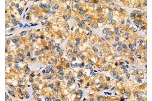 ABIN6260047 and ABIN6276484 at 1/100 staining Human kidney cancer by IHC-P.