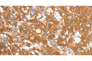 Immunohistochemistry of paraffin-embedded Human thyroid cancer using WNT3A Polyclonal Antibody at dilution of 1:40 (WNT3A Antikörper)