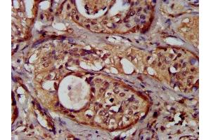 IHC image of ABIN7162085 diluted at 1:300 and staining in paraffin-embedded human cervical cancer performed on a Leica BondTM system. (NUMBL Antikörper  (AA 447-576))