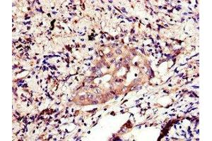 Immunohistochemistry of paraffin-embedded human lung cancer using ABIN7155812 at dilution of 1:100 (Nanog Antikörper  (AA 1-305))