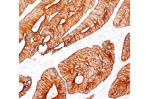 IHC testing of human colon carcinoma stained with Cytokeratin 8 antibody (K8/383). (KRT8 Antikörper)