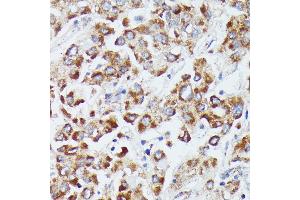 Immunohistochemistry of paraffin-embedded human liver cancer using DUT antibody (ABIN7266736) at dilution of 1:100 (40x lens).