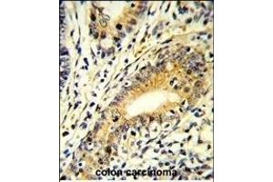 Formalin-fixed and paraffin-embedded human colon carcinoma reacted with FB Antibody (N-term), which was peroxidase-conjugated to the secondary antibody, followed by DAB staining. (FAM3B Antikörper  (N-Term))