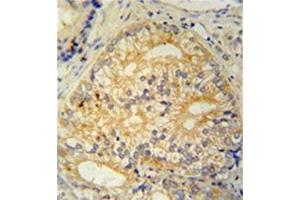 Formalin fixed and paraffin embedded human prostate carcinoma stained with CP013 Antibody (N-term) followed by peroxidase conjugation of the secondary antibody and DAB staining.