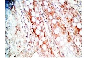 Human colon cancer tissue was stained by Rabbit Anti-Gastrin Releasing Peptide (Porcine) Antibody (Gastrin-Releasing Peptide Antikörper)