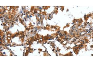 Immunohistochemistry of paraffin-embedded Human thyroid cancer tissue using DEFA4 Polyclonal Antibody at dilution 1:40 (DEFA4 Antikörper)