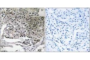 Immunohistochemistry analysis of paraffin-embedded human breast carcinoma tissue, using PIGY Antibody. (PIGY Antikörper  (AA 3-52))