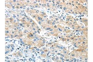 The image on the left is immunohistochemistry of paraffin-embedded Human liver cancer tissue using ABIN7190846(GPR15 Antibody) at dilution 1/20, on the right is treated with synthetic peptide. (GPR15 Antikörper)