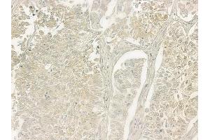 ABIN6257413 and ABIN6275351 at 1/100 staining human lung squamous cell carcinoma by IHC-P.