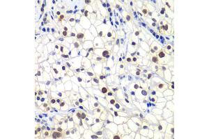 Immunohistochemistry of paraffin-embedded human kidney cancer using GTF2F2 antibody. (GTF2F2 Antikörper)