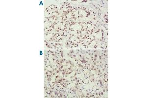 Immunohistochemical analysis of paraffin-embedded human breast cancer (A) and lung cancer (B) tissues, showing nuclear localization using MSH2 monoclonal antibody, clone 3A2B8C  with DAB staining. (MSH2 Antikörper)