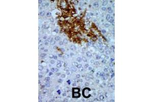 Formalin-fixed and paraffin-embedded human cancer tissue reacted with the primary antibody, which was peroxidase-conjugated to the secondary antibody, followed by AEC staining. (PNCK Antikörper  (C-Term))