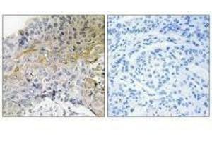 Immunohistochemical analysis of paraffin-embedded human breast carcinoma tissue using p130 Cas (Ab-410) antibody. (BCAR1 Antikörper  (Tyr410))