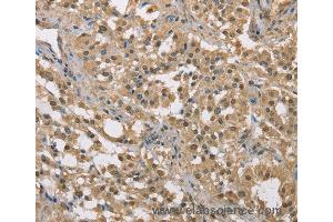 Immunohistochemistry of Human liver cancer using DACH2 Polyclonal Antibody at dilution of 1:40 (DACH2 Antikörper)
