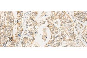 Immunohistochemistry of paraffin-embedded Human gastric cancer tissue using EIF2S2 Polyclonal Antibody at dilution of 1:35(x200) (EIF2S2 Antikörper)