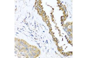 Immunohistochemistry of paraffin-embedded human lung cancer using DFNA5 antibody at dilution of 1:100 (x40 lens). (DFNA5 Antikörper)