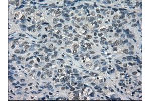 Immunohistochemical staining of paraffin-embedded Carcinoma of thyroid tissue using anti-BUB1Bmouse monoclonal antibody. (BUB1B Antikörper)