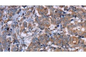 Immunohistochemistry of paraffin-embedded Human breast cancer using PON1 Polyclonal Antibody at dilution of 1:40 (PON1 Antikörper)