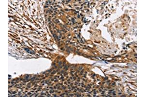 The image on the left is immunohistochemistry of paraffin-embedded Human esophagus cancer tissue using ABIN7190317(CNGA1 Antibody) at dilution 1/40, on the right is treated with synthetic peptide. (CNGA1 Antikörper)