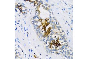 Immunohistochemistry of paraffin-embedded Human breast using PTCH1 antibody (ABIN1682368, ABIN1682367, ABIN3015342, ABIN3015343 and ABIN6213997) at dilution of 1:100 (40x lens). (Patched 1 Antikörper  (AA 1214-1312))
