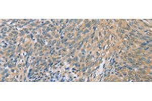 Immunohistochemistry of paraffin-embedded Human cervical cancer tissue using ZHX3 Polyclonal Antibody at dilution of 1:100(x200) (ZHX3 Antikörper)