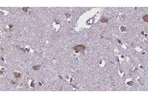 ABIN6275754 at 1/100 staining Human brain cancer tissue by IHC-P. (GNE Antikörper)