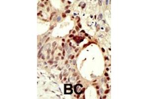 Formalin-fixed and paraffin-embedded human cancer tissue reacted with the primary antibody, which was peroxidase-conjugated to the secondary antibody, followed by DAB staining. (DNMT3L Antikörper  (C-Term))