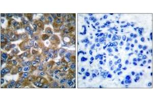 Immunohistochemistry analysis of paraffin-embedded human breast carcinoma tissue, using Keratin 15 Antibody.
