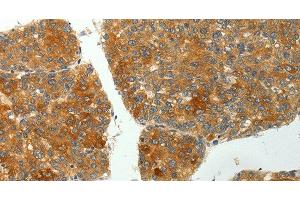 Immunohistochemistry of paraffin-embedded Human liver cancer using SH-PTP1 Polyclonal Antibody at dilution of 1:35 (SHP1 Antikörper)