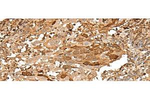 Immunohistochemistry of paraffin-embedded Human cervical cancer tissue using PIEZO2 Polyclonal Antibody at dilution of 1:55(x200) (PIEZO2 Antikörper)