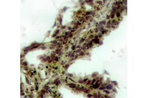 Immunohistochemistry (IHC) image for anti-V-Akt Murine Thymoma Viral Oncogene Homolog 1 (AKT1) (pThr308) antibody (ABIN3020076) (AKT1 Antikörper  (pThr308))