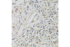 Immunohistochemistry of paraffin-embedded human prostate cancer using SMARCC2 antibody. (SMARCC2 Antikörper)