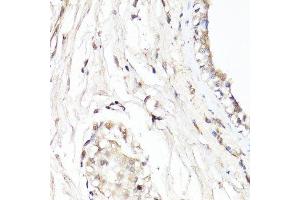 Immunohistochemistry of paraffin-embedded human breast using CDK7 antibody. (CDK7 Antikörper  (AA 211-346))