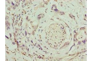 Immunohistochemistry of paraffin-embedded human pancreatic cancer using ABIN7171798 at dilution of 1:100 (SLC26A8 Antikörper  (AA 414-595))