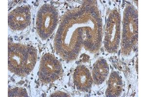 IHC-P Image Immunohistochemical analysis of paraffin-embedded human colon carcinoma, using DNAJB12, antibody at 1:500 dilution.
