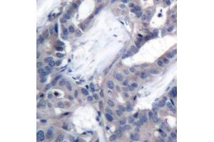 Immunohistochemistry of paraffin-embedded human breast carcinoma using Phospho-MAP2K2-T394 antibody (ABIN2987359). (MEK2 Antikörper  (pThr394))