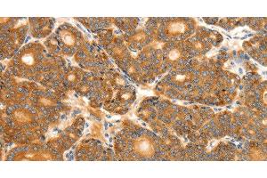 Immunohistochemistry of paraffin-embedded Human thyroid cancer tissue using SCT Polyclonal Antibody at dilution 1:40 (Secretin Antikörper)