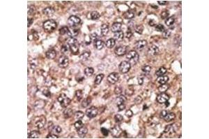 IHC analysis of FFPE human hepatocarcinoma tissue stained with the SIRT5 antibody (SIRT5 Antikörper  (AA 263-292))