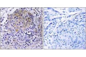 Immunohistochemistry analysis of paraffin-embedded human breast carcinoma tissue, using CEP78 Antibody. (CEP78 Antikörper  (AA 301-350))