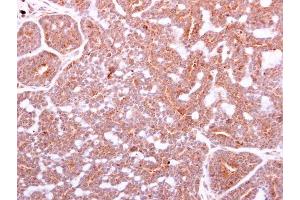 IHC-P Image IGF1 antibody detects IGF1 protein at cytoplasm on human breast carcinoma by immunohistochemical analysis. (IGF1 Antikörper)