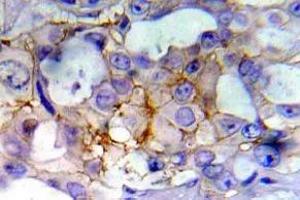 Immunohistochemistry (IHC) analyzes of p-EGFR antibody in paraffin-embedded human breast carcinoma tissue. (EGFR Antikörper  (pTyr1197))