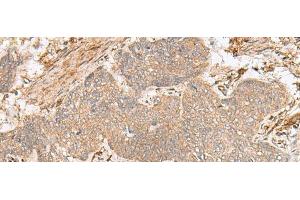 Immunohistochemistry of paraffin-embedded Human esophagus cancer tissue using FBXW8 Polyclonal Antibody at dilution of 1:65(x200) (FBXW8 Antikörper)