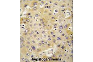 Formalin-fixed and paraffin-embedded human hepatocarcinoma tissue reacted with PPBP antibody , which was peroxidase-conjugated to the secondary antibody, followed by DAB staining.